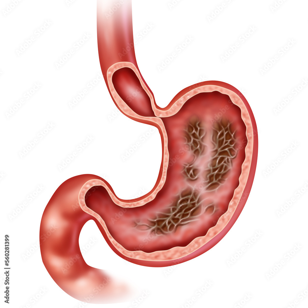 Gastritis Stomach Disease as an inflammation of the inner lining of the digestive organ with symptoms of abdominal pain as a symbol for Gastroenterology Gastritis Stomach Disease as an inflammation of the inner lining of the digestive organ with symptoms of abdominal pain as a symbol for Gastroenterology
