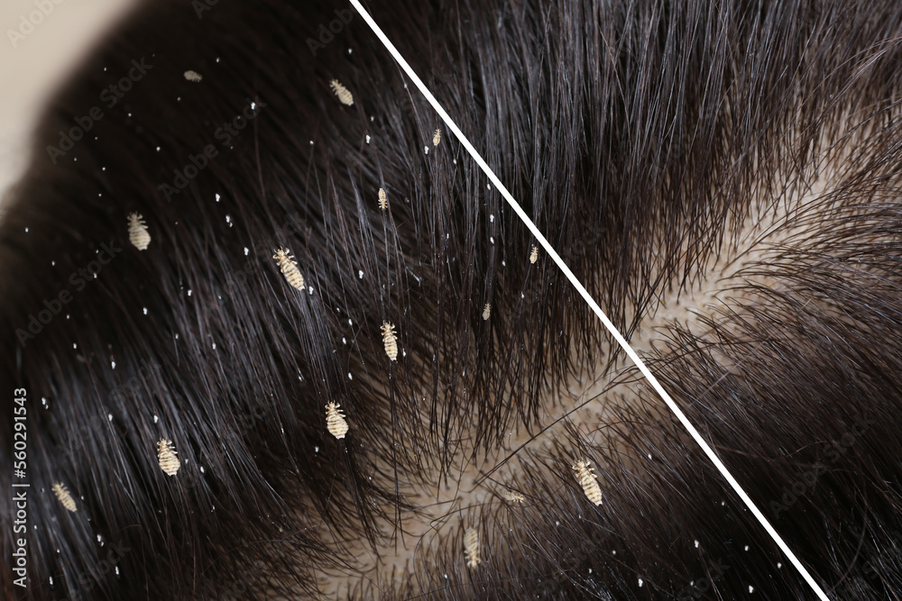 Collage showing woman's hair before and after lice treatment, closeup
