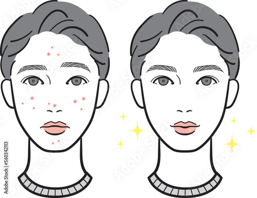 ニキビに悩んでいる若い男性のビフォーアフター