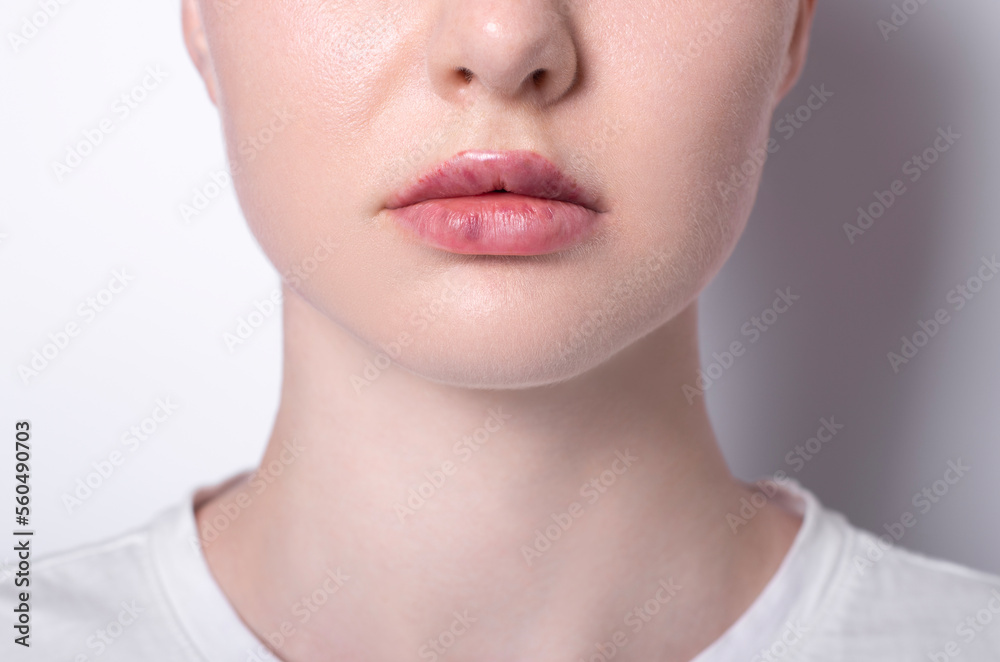 real women's bruised lips after lip augmentation injection of hyaluronic acid close-up, complications and hematomas after a beauty hyaluronan injection on female lips, contour lip plastic surgery real women's bruised lips after lip augmentation injection of hyaluronic acid close-up, complications and hematomas after a beauty hyaluronan injection on female lips, contour lip plastic surgery