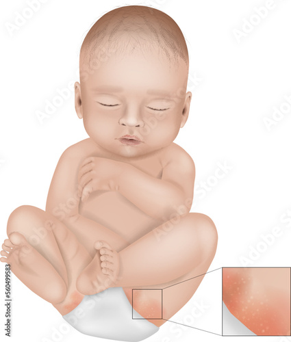 Diaper Rash or Irritant Diaper Dermatitis. Inflammation of the skin under a diaper. Jacquet Dermatitis. Infant with diaper rash in groin area. photo