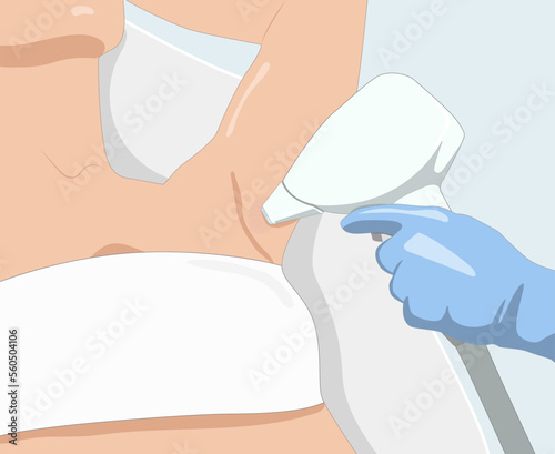 Illustration.Elos epilation, hair removal procedure on a woman’s body. Beautician doing laser rejuvenation in a beauty salon. Removing unwanted body hair.	

