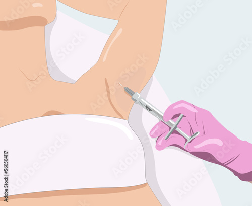 illustration.The doctor makes injections of botulinum toxin in the underarm area against hyperhidrosis. Women's cosmetology concept.