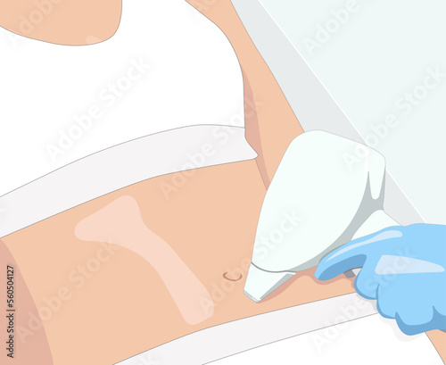 Illustration.Elos epilation, hair removal procedure on a woman’s body. Beautician doing laser rejuvenation in a beauty salon. Removing unwanted body hair.	
