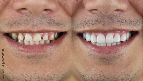 Obraz na plátně smile makeover porcelain laminated veneers result
