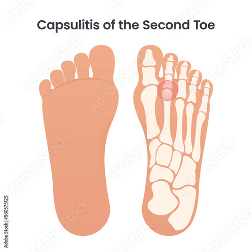 Capsulitis of the Second Bone educational medical vector illustration photo