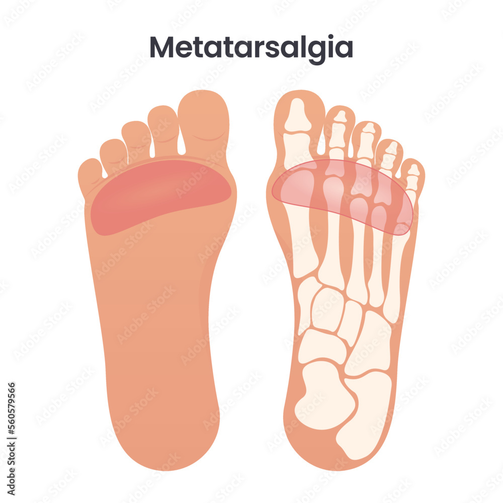 Metatarsalgia Pain in the Ball of the Foot medical educational vector illustration graphic Metatarsalgia Pain in the Ball of the Foot medical educational vector illustration graphic