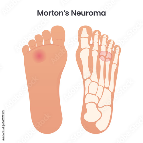 Morton's Neuroma medical educational vector illustration graphic photo