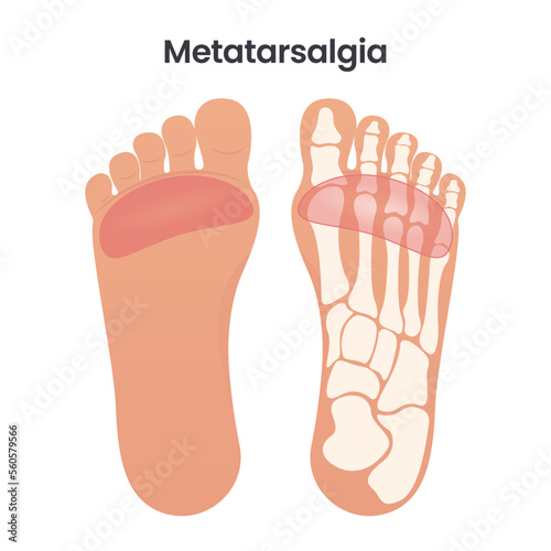 Metatarsalgia Pain in the Ball of the Foot medical educational vector illustration graphic