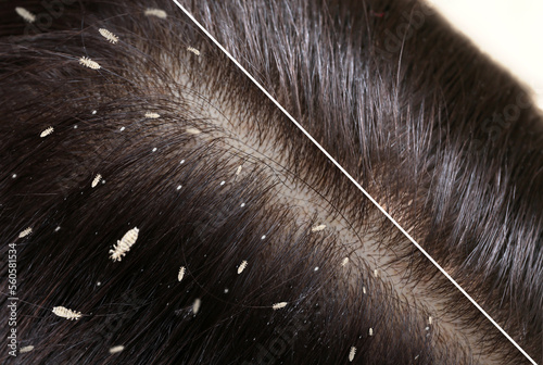 Collage showing woman's hair before and after lice treatment, closeup. Suffering from pediculosis photo