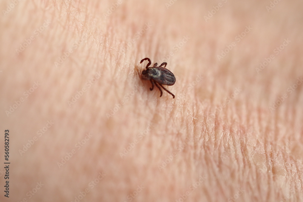 mite,Ixodid, encephalitic live tick on the human body close-up, macro photography. mite,Ixodid, encephalitic live tick on the human body close-up, macro photography.