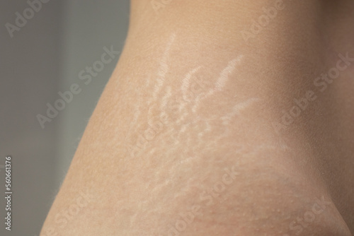 Stretch marks on womans back. Scars from stretch marks on the back of the lower back