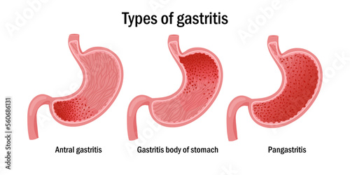 Localization of gastritis, including pangastritis, antral and body of stomach gastritis. Vector illustration, cartoon style, white background
 photo