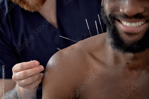 Εκτύπωση καμβά acupuncture therapy on back spine shoulders for black male client