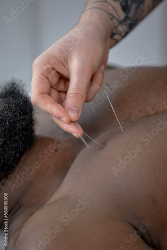 professional doctor performing acupuncture therapy on chest for black male client. close-up.man undergoing acupuncture treatment with a line of needles inserted into body skin in hospital