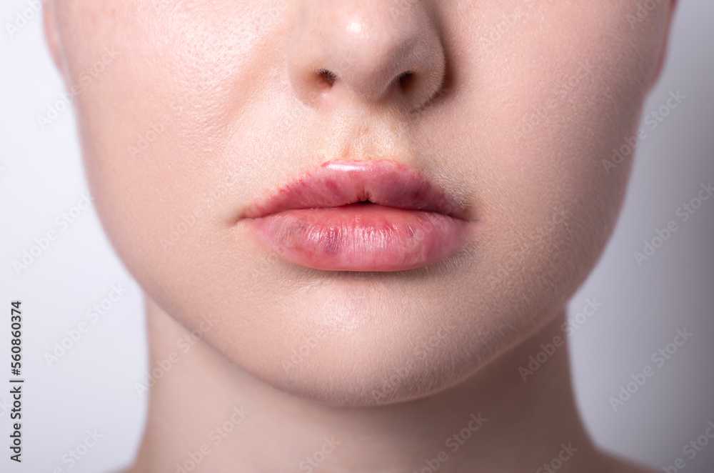 real women's bruised lips after lip augmentation injection of