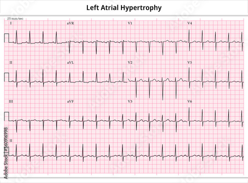 ECG Left Atrial Hypertrophy (LAH) - Left Atrial Enlargement (LAE) - 12 Lead ECG Common Case - 3 Sec/lead - Electrocardiogram Medical Vector Illustration