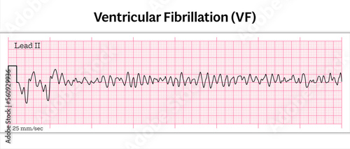 ECG Ventricular Fibrillation (VF) - 8 Second ECG Paper - Vector Medical Illustration photo