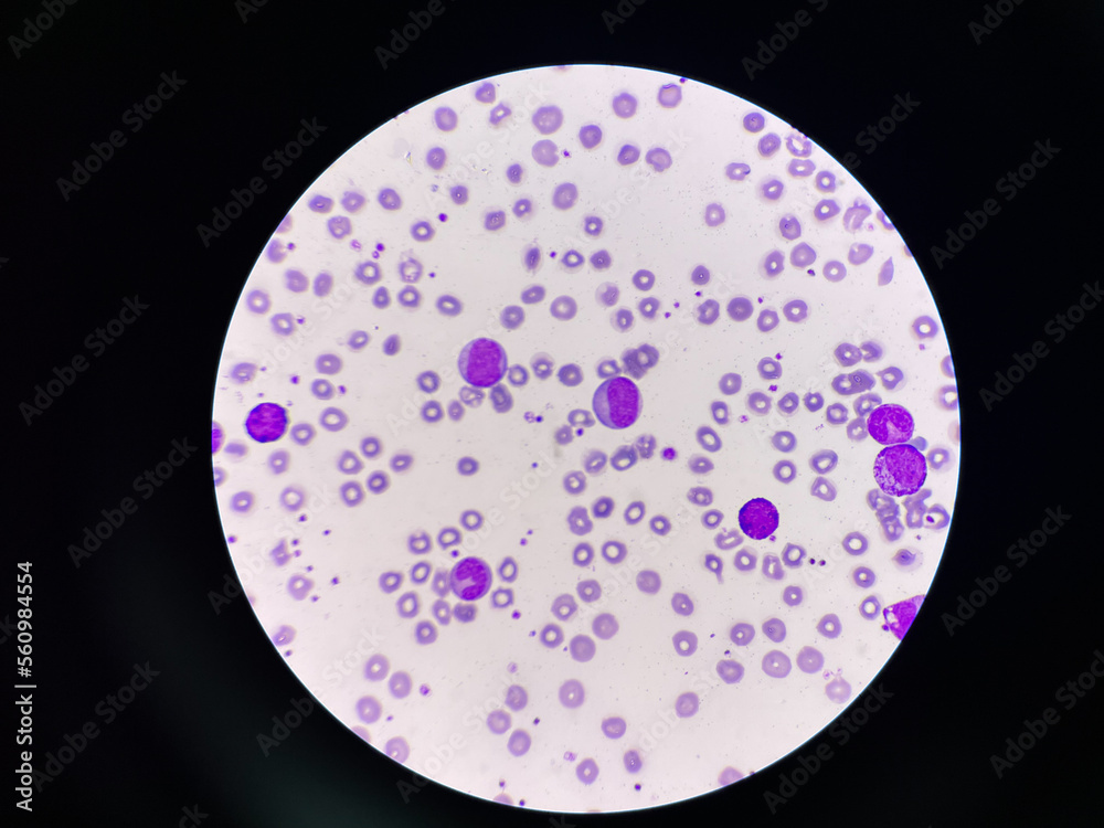 Image showcasing Leukemia blood picture show immature cells mixed stage. Stock Photo ...