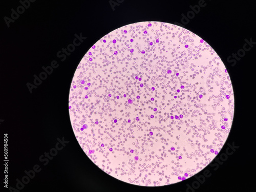 Leukemia blood picture show immature cells mixed stage.