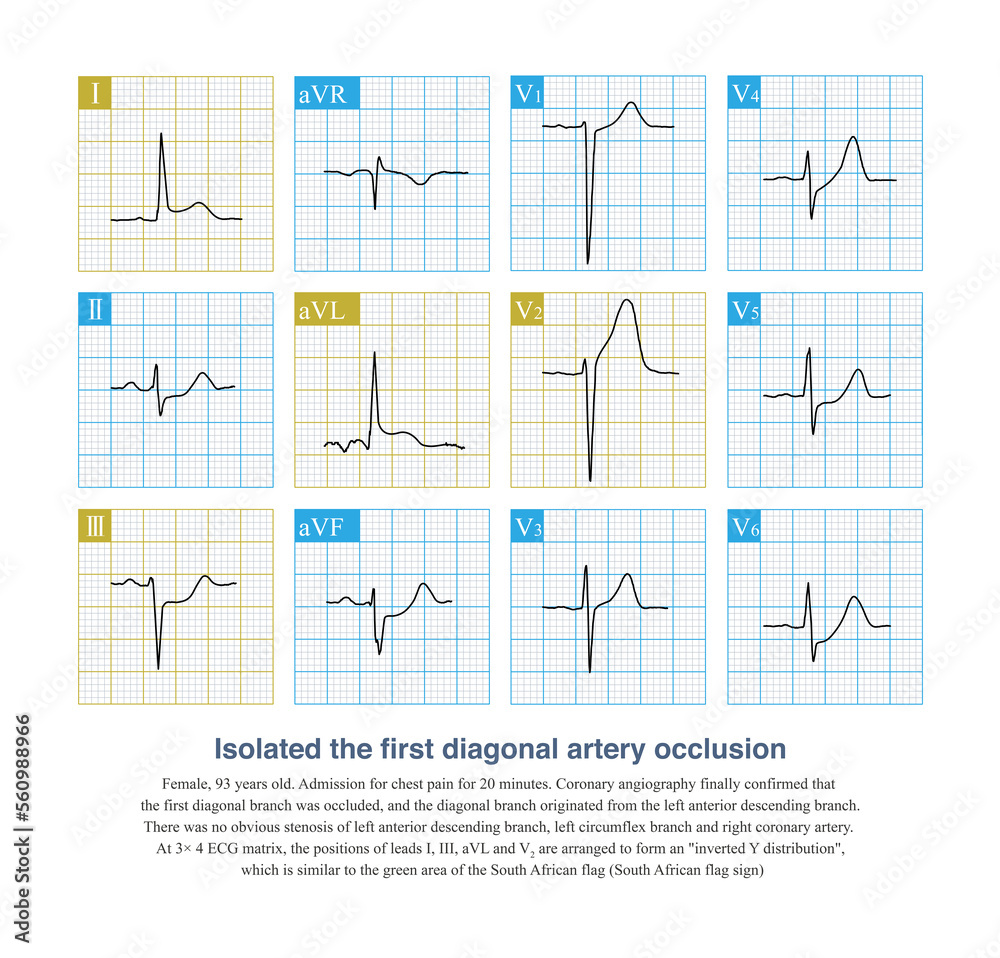 When the isolated first diagonal artery is occluded, ECG can show ST segment elevation in leads I, aVL, and V2, and ST segment depression in lead III, and the layout resembles the South African flag. When the isolated first diagonal artery is occluded, ECG can show ST segment elevation in leads I, aVL, and V2, and ST segment depression in lead III, and the layout resembles the South African flag.