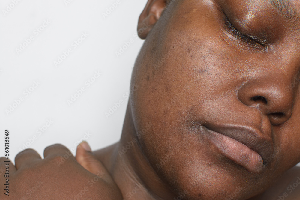 Naklejka premium Brown skin with dark spots, hyperpigmentation on brown skin, african american woman with skin blemishes, imperfect skin