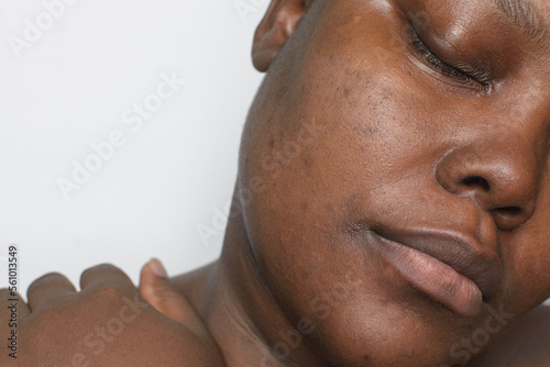Brown skin with dark spots, hyperpigmentation on brown skin, african american woman with skin blemishes, imperfect skin photo