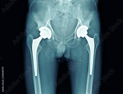 Bilateral hip replacement on black background  photo