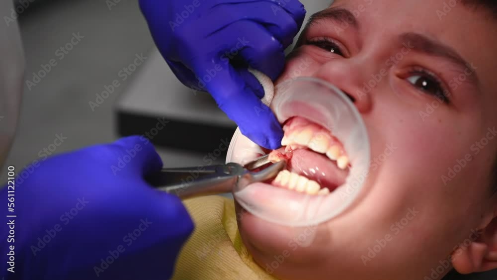 Extreme closeup of a doctor dentist surgeon, using stainless steel