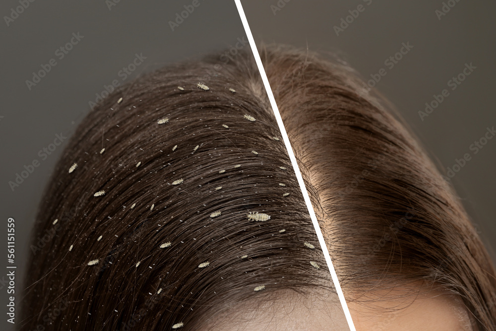 Collage showing woman's hair before and after lice treatment on grey background, closeup