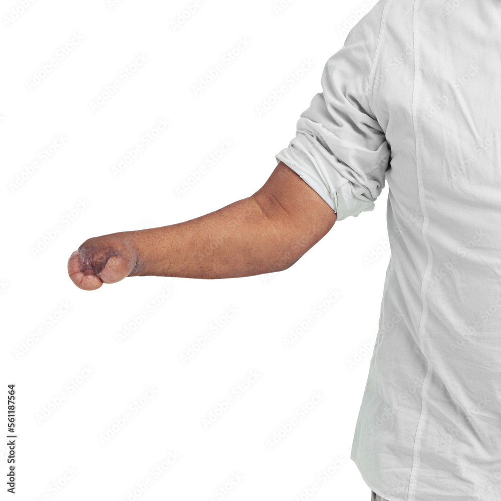 Hand, disability and mockup with a man in studio isolated on a white background after an accident or injury. Medical, deformity and amelia with a disabled male on a blank space for awareness Hand, disability and mockup with a man in studio isolated on a white background after an accident or injury. Medical, deformity and amelia with a disabled male on a blank space for awareness