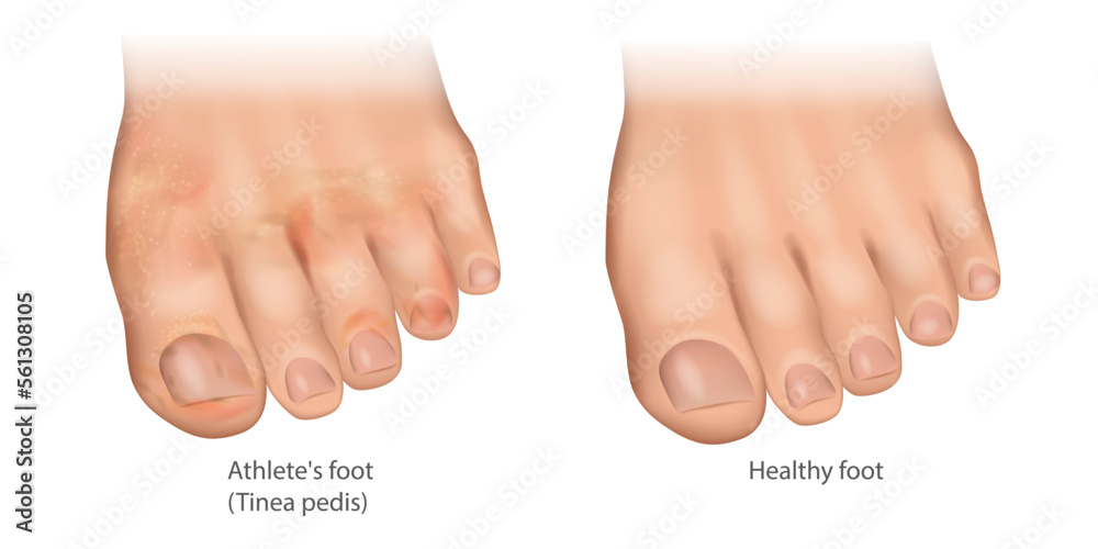 Illustration of the Athlete's foot and Healthy foot. Tinea pedis or ringworm  of the foot, moccasin foot. Skin infection of the feet caused by a fungus.  Stock Vector