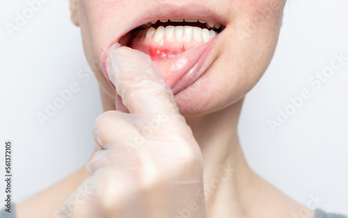 Closeup aphthous stomatitis on gum. Doctor checks small ulcer in woman's mouth. Physician's hand in glove pulls female Caucasian's lip, white background. Diagnosis and treatment concept. Horizontal photo