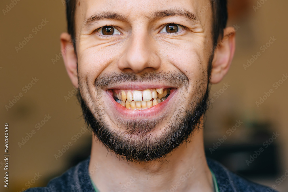 Ταπετσαρία Young man showing crooked growing teeth