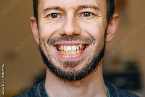 Young man showing crooked growing teeth. The man needs to go to the dentist to install braces.