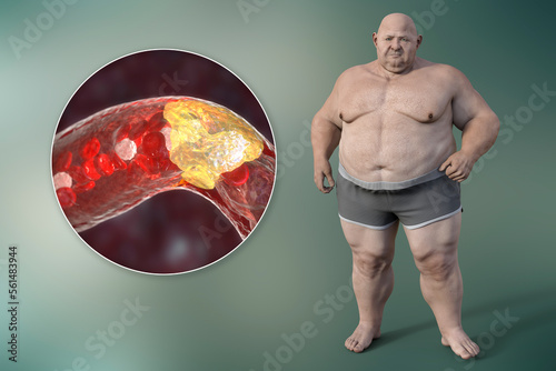 Obesity and atherosclerosis, conceptual 3D illustration. Atheromatous plaque inside artery leading to narrowing of blood vessel in an obese person. Obese man 3D render not based on any photo photo