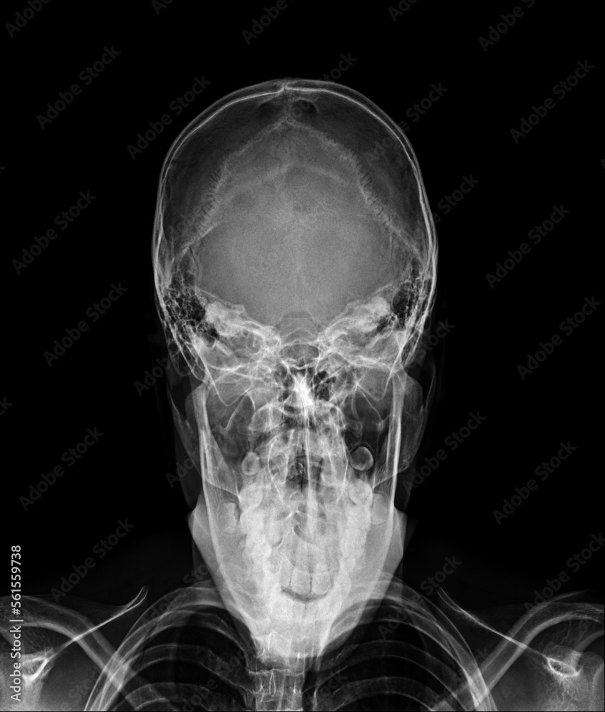 X-ray AP towns skull view X-ray AP towns skull view