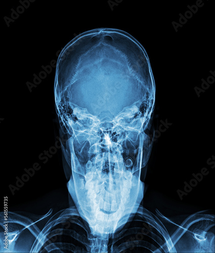 X-ray AP towns skull view