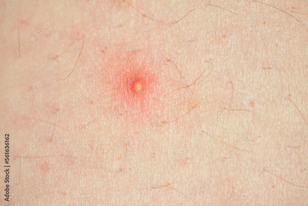 Fototapeta premium Acne, pus pimples, suppurating pimple, burst pimple with leaking pus closeup with shallow depth of field