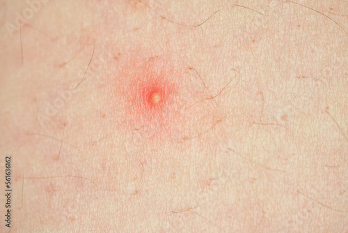 Acne, pus pimples, suppurating pimple, burst pimple with leaking pus closeup with shallow depth of field photo
