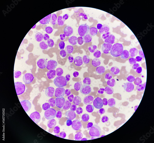 Blood smear leukaemia white blood cells blast. photo