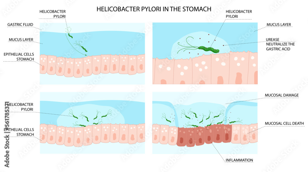Helicobacter pylori infection process in stomach with inflammation development