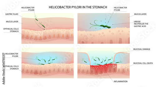 Helicobacter pylori infection process in human stomach with gastritis photo