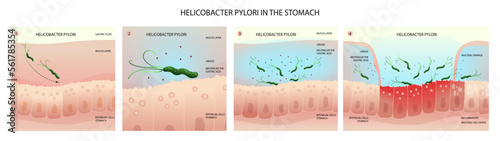 Helicobacter pylori in human stomach, inflammation development stages