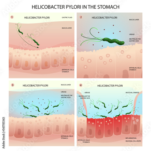 Helicobacter pylori infection process in human stomach with gastritis development