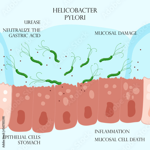 Helicobacter pylori in mucosal layer on inflamed epithelial cells in stomach