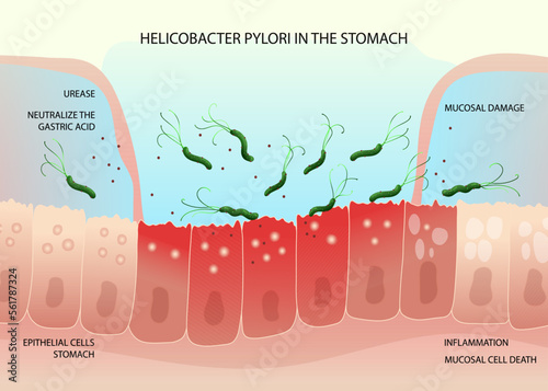 Helicobacter pylori bacteria on inflamed epithelial cells in human stomach