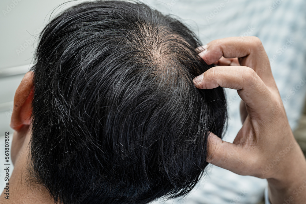 Naklejka premium Bald in the middle head and begin no loss hair glabrous of mature Asian business smart active office man.