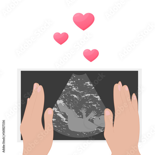 Ultrasound examination procedure. Pregnancy. An embryo in an ultrasound scan. The expectant mother holds a photo of the child in her hands. photo an embryo