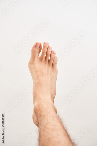 Bone on the foot. Hallux valgus disease